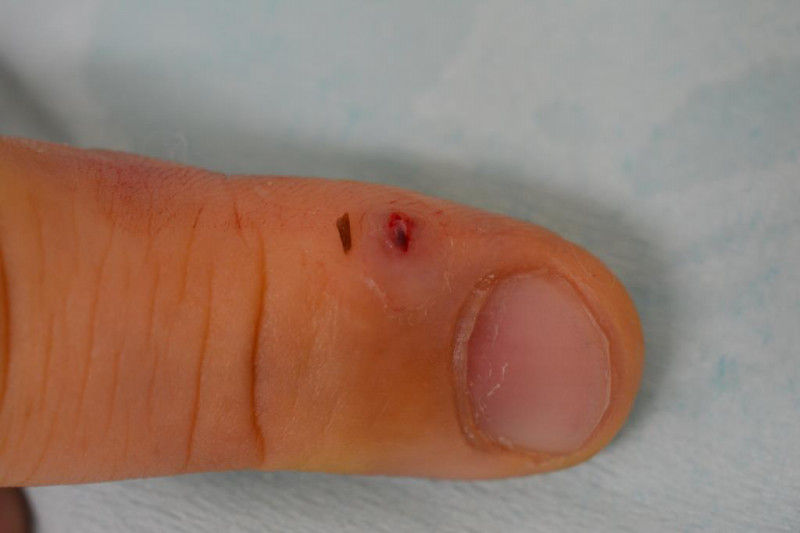 2週間前にバラのトゲが指に刺さって腫れてきた シャルムクリニックblog
